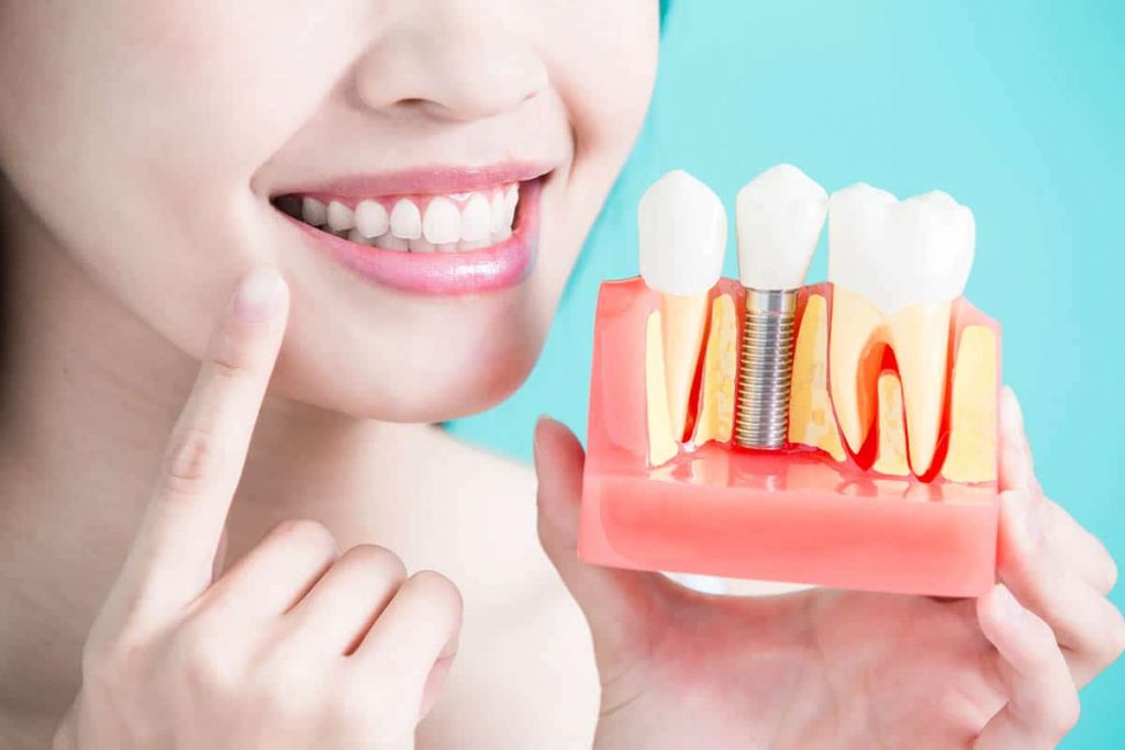 How dental profession helps in dealing and placement of implants?