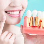 Dental implants Singapore cost